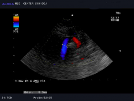 Ultrazvok možganskih žil - vertebralna arterija, normalen izvid
